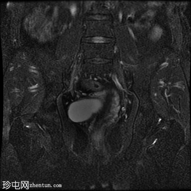 输卵管积水（MRI）