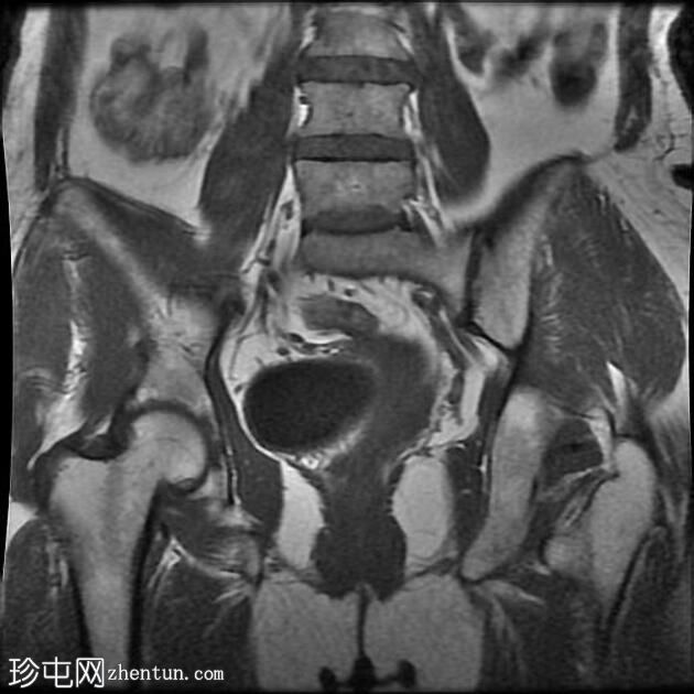 输卵管积水（MRI）