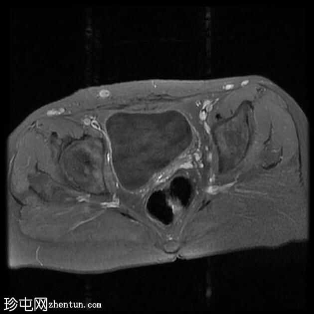 输卵管积水（MRI）