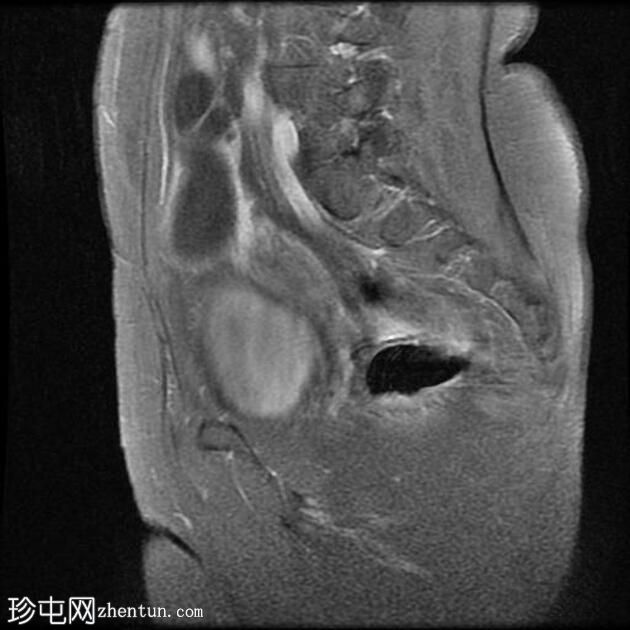 输卵管积水（MRI）