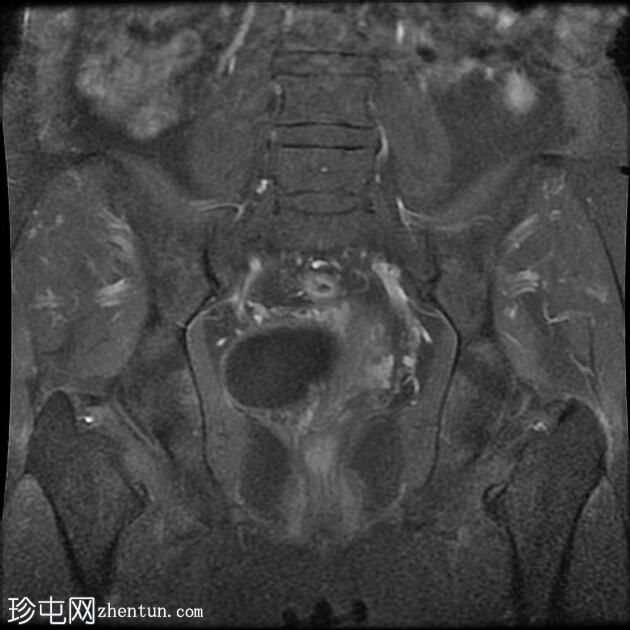 输卵管积水（MRI）