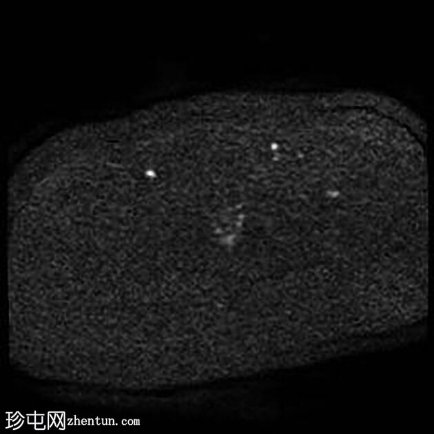 输卵管积水（MRI）