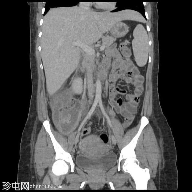 子宫缝线裂开和输卵管卵巢脓肿