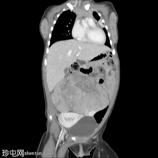 卵巢幼年性颗粒细胞瘤（JGCT）