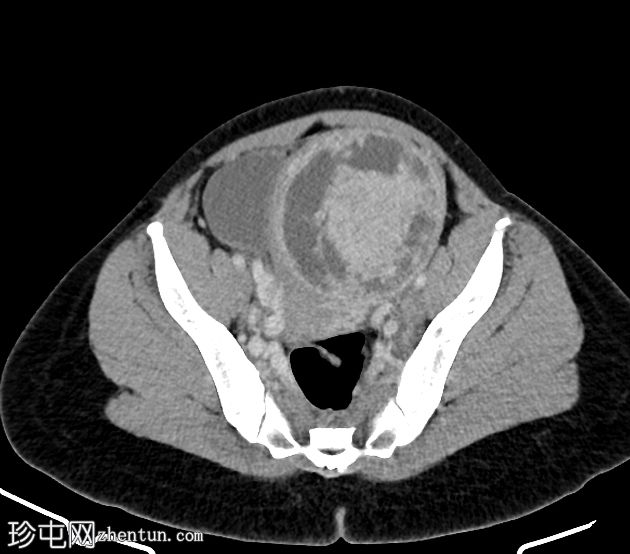 巨大子宫肌瘤和盆腔充血