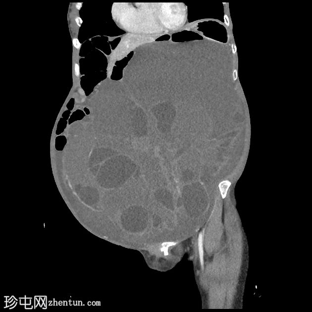 卵巢浆液性囊腺纤维瘤