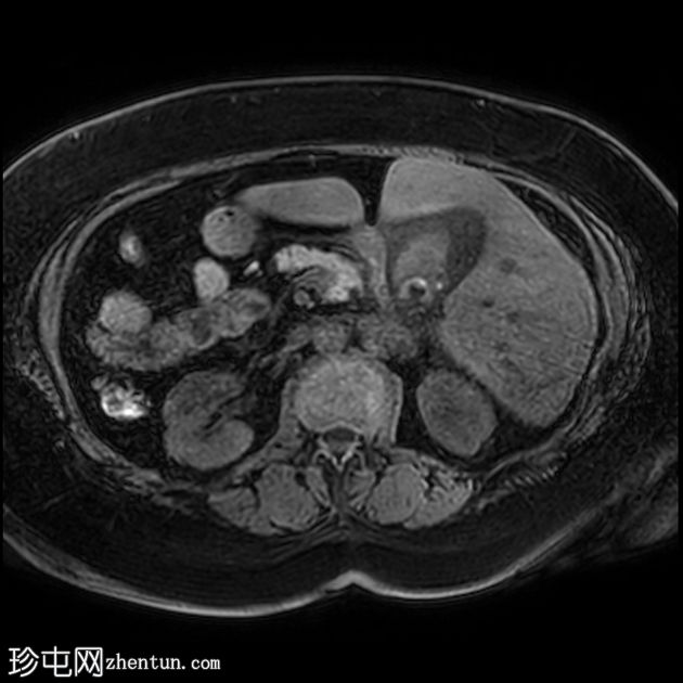 急性出血性胆囊炎和内脏反位