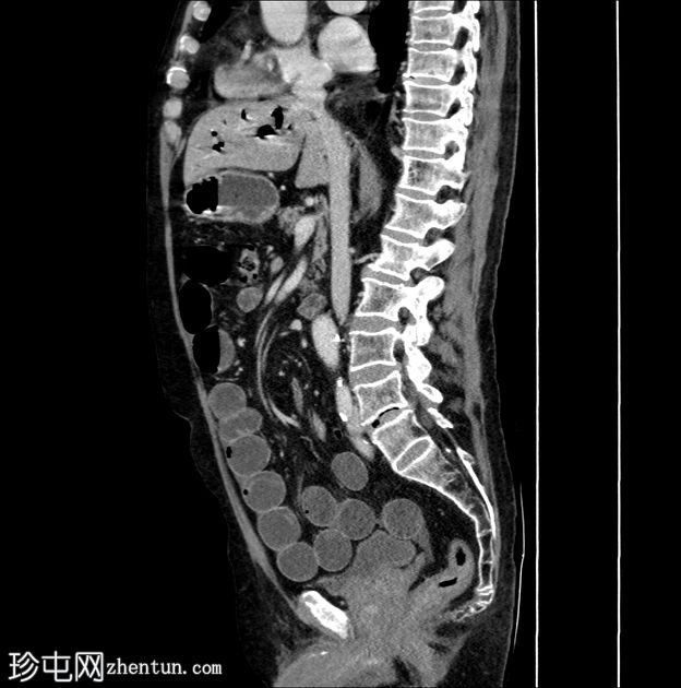 闭环肠梗阻