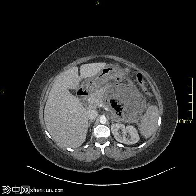 坏死性胰腺炎