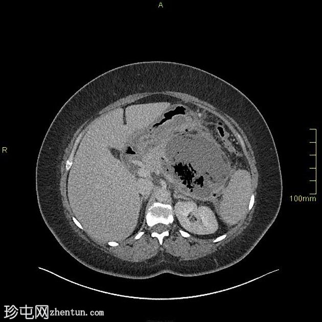 坏死性胰腺炎