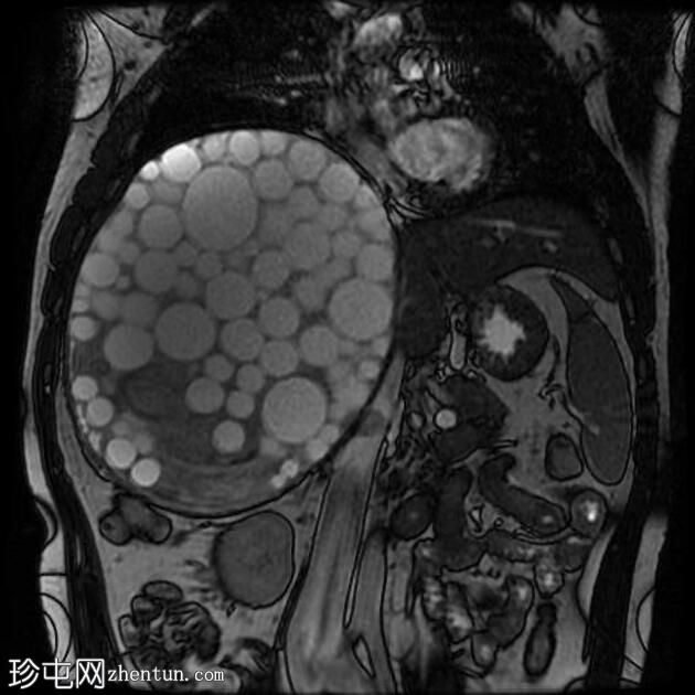 大型肝包虫囊肿