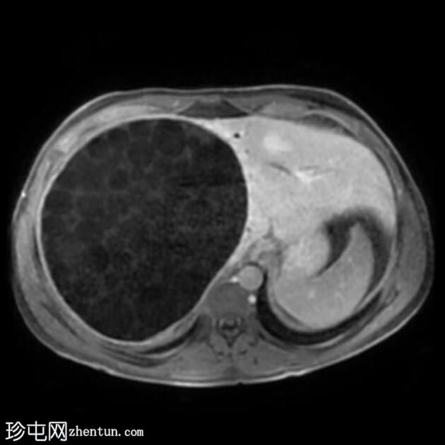 大型肝包虫囊肿