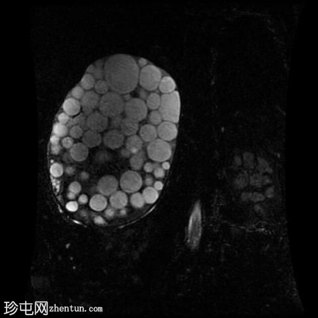 大型肝包虫囊肿