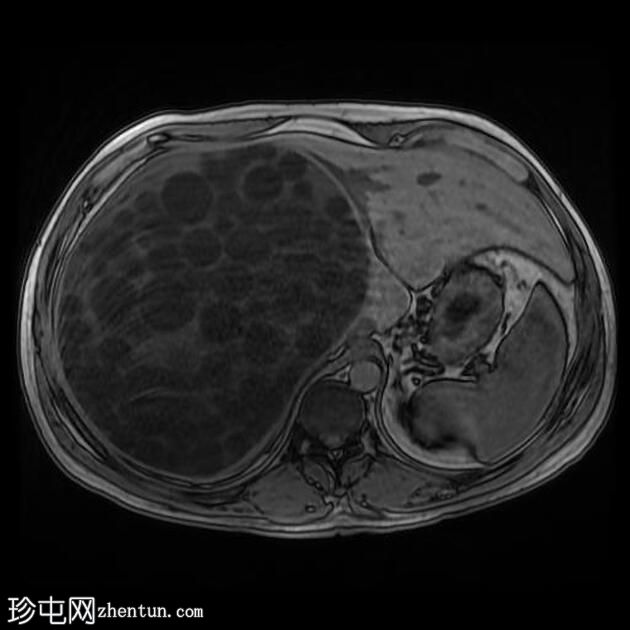 大型肝包虫囊肿