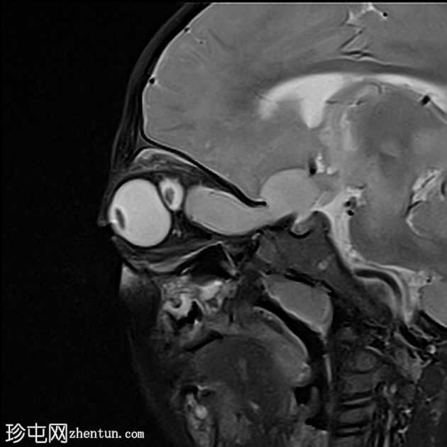 双侧视神经通路胶质瘤