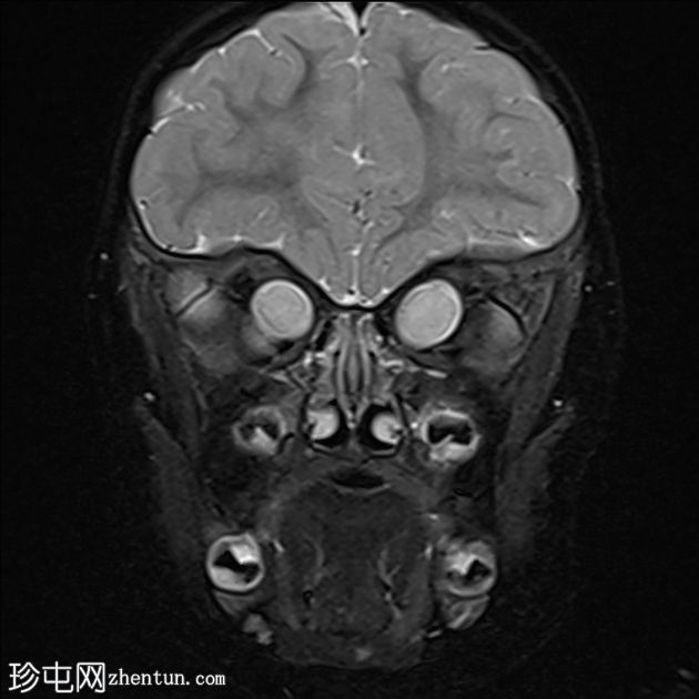 双侧视神经通路胶质瘤