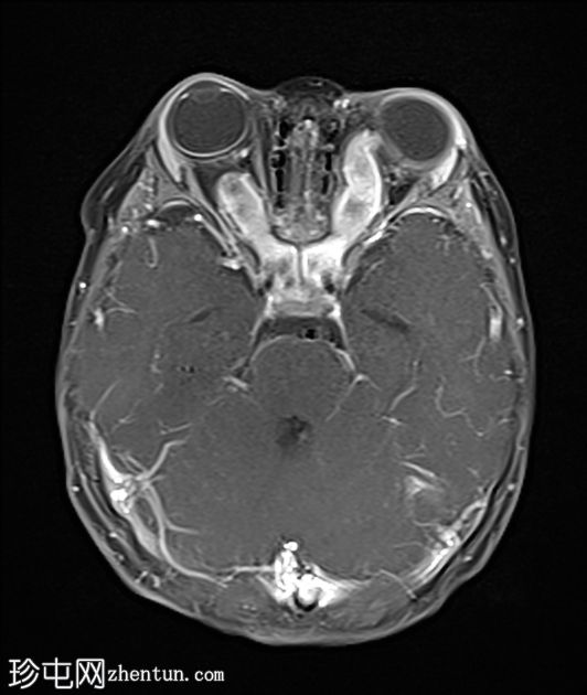 双侧视神经通路胶质瘤