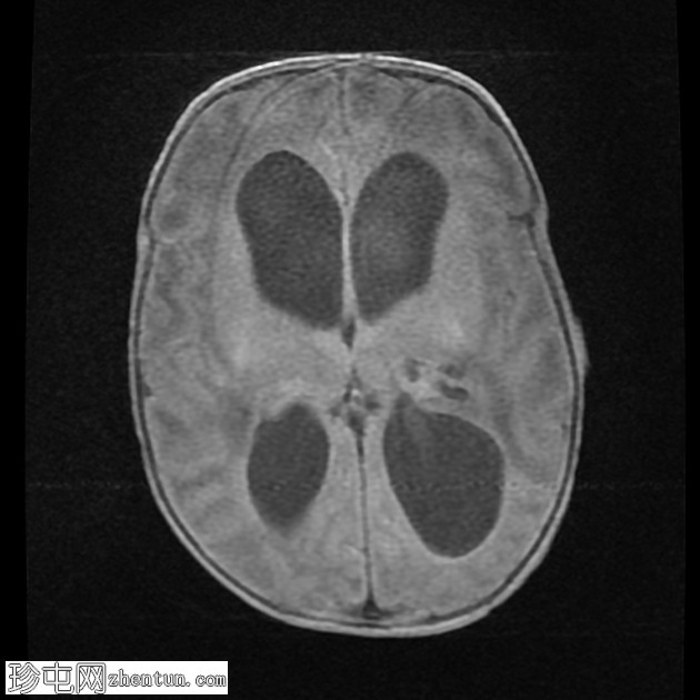 伴有阻塞性脑积水的脑室炎