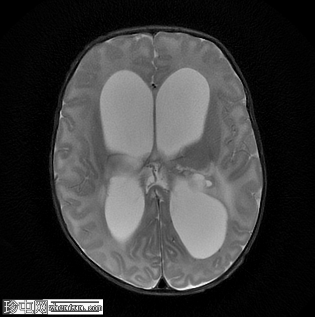 伴有阻塞性脑积水的脑室炎