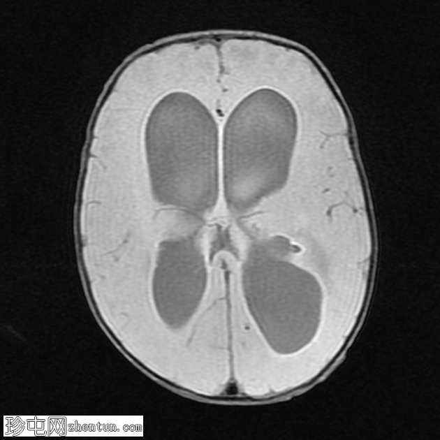 伴有阻塞性脑积水的脑室炎