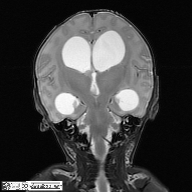 伴有阻塞性脑积水的脑室炎