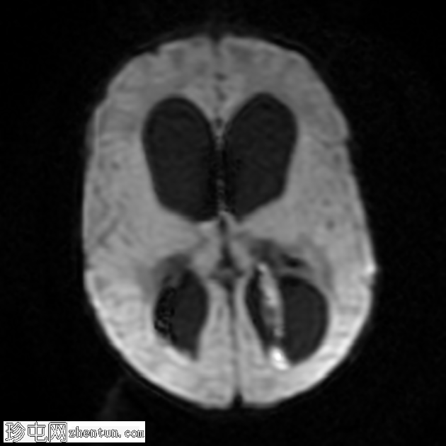 伴有阻塞性脑积水的脑室炎