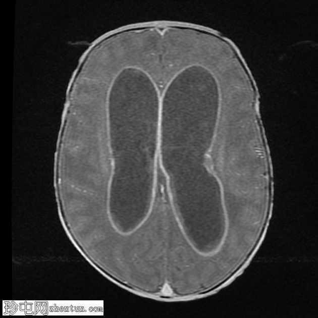 伴有阻塞性脑积水的脑室炎