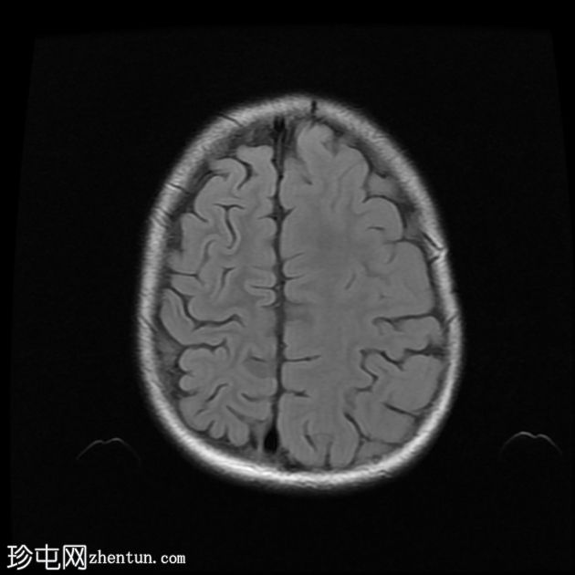 半侧巨脑畸形伴多小脑回畸形