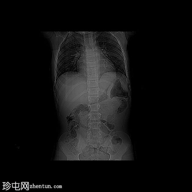 左主支气管异物