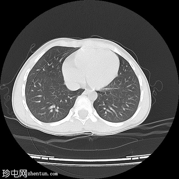 左主支气管异物