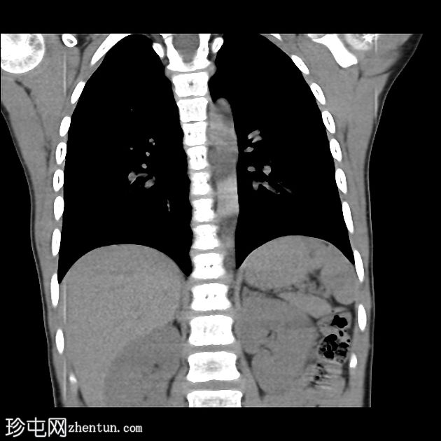 左主支气管异物