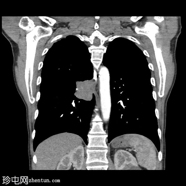 致密肺门征