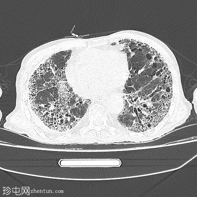 普通型间质性肺炎