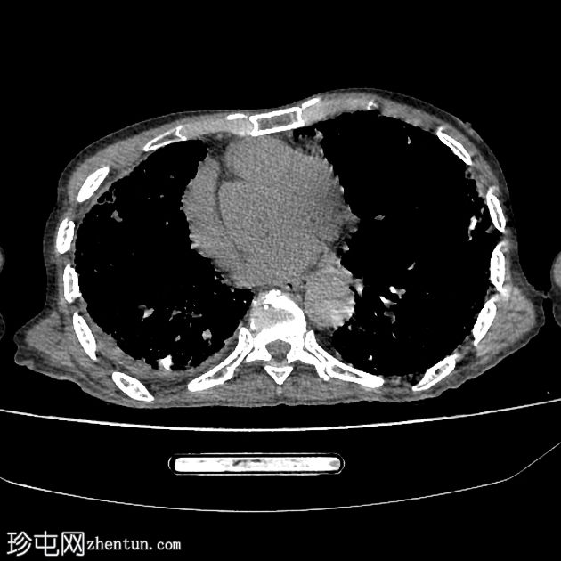 普通型间质性肺炎