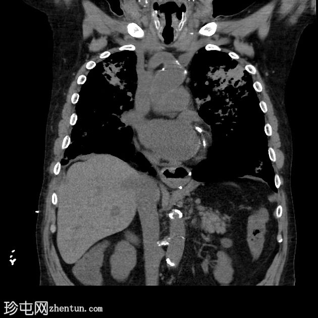 弥漫性肺泡出血