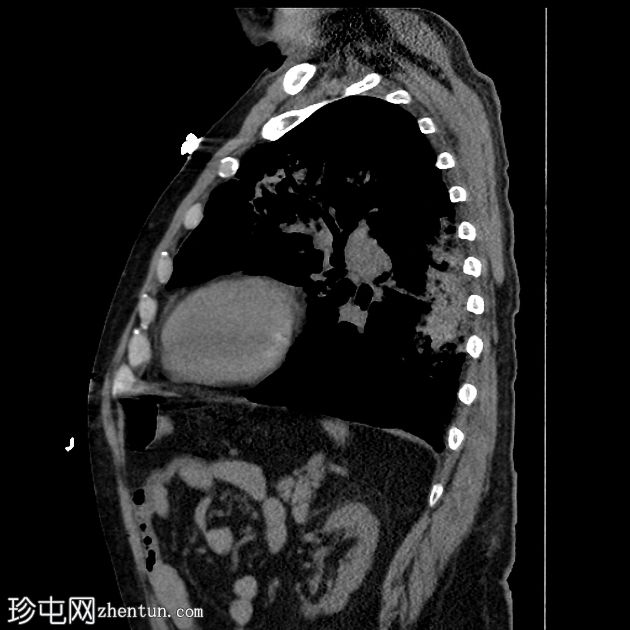 弥漫性肺泡出血