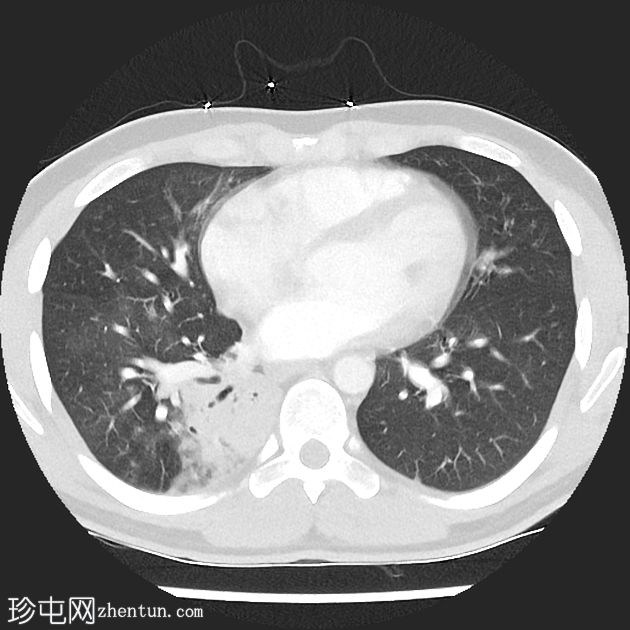 支气管闭锁