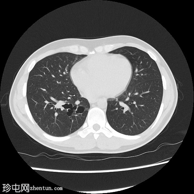 支气管闭锁