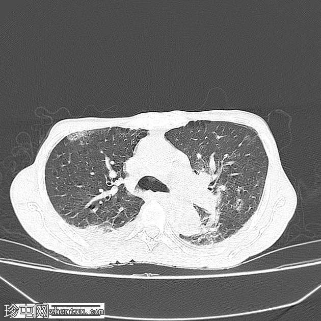 漏斗胸感染 COVID 19