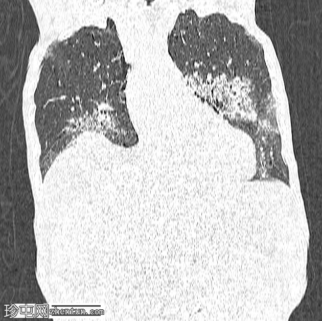 漏斗胸感染 COVID 19