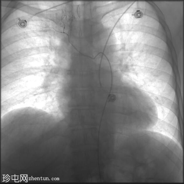 支气管动脉栓塞