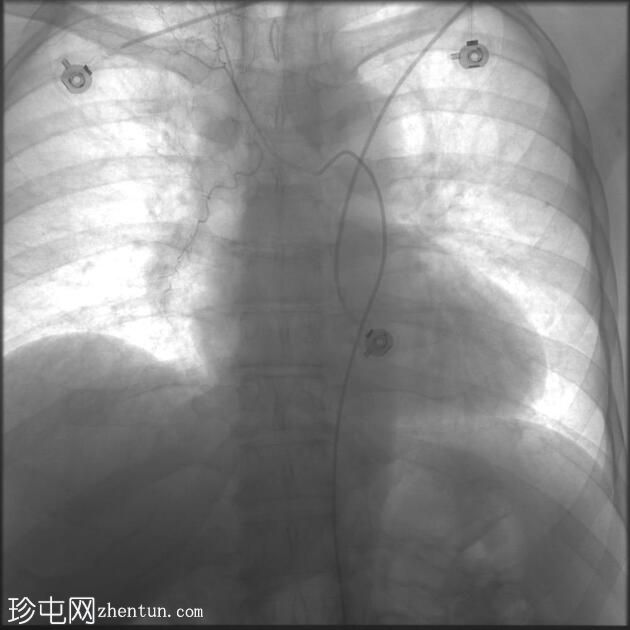 支气管动脉栓塞