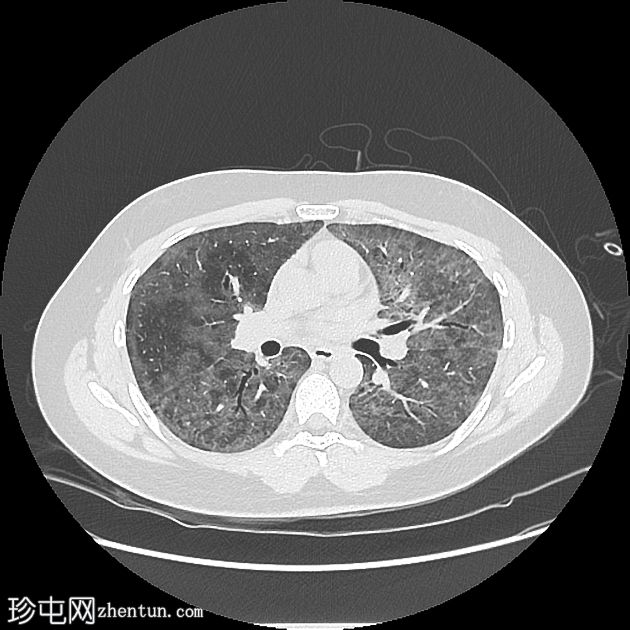 耶氏肺孢子虫肺炎