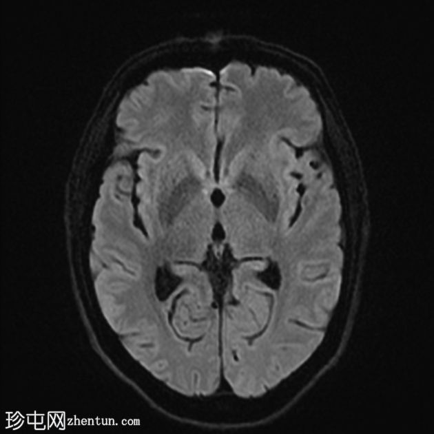 隐球菌病