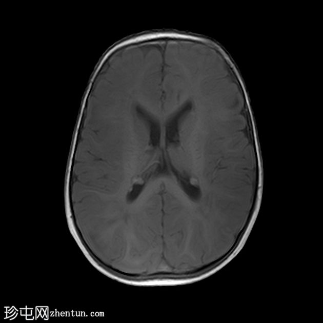 结节性硬化症