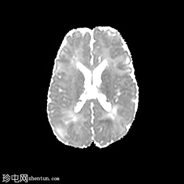 结节性硬化症