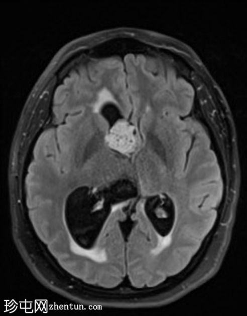 室管膜下瘤-侧脑室