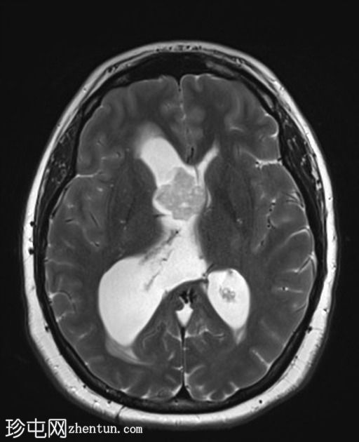 室管膜下瘤-侧脑室