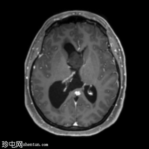 室管膜下瘤-侧脑室