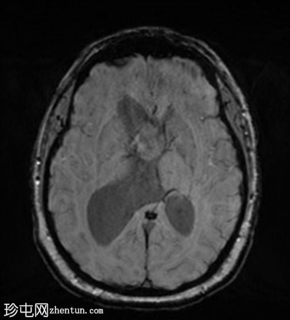 室管膜下瘤-侧脑室